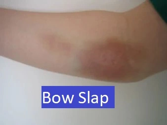bow slap injury